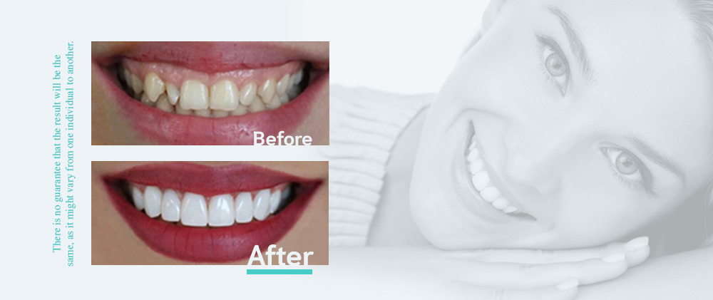 Hollywood_Smile_BA