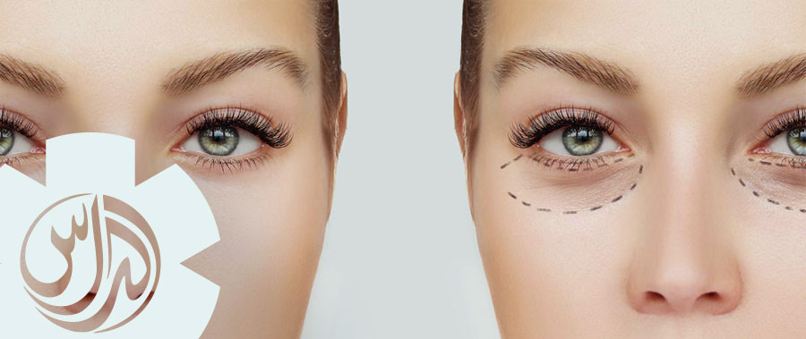 Medical Eye Bag Treatment, Dubai