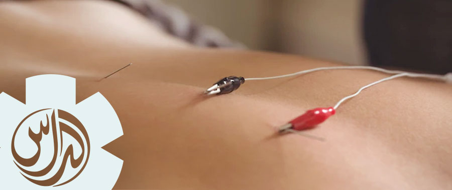 https://www.aldasclinic.com/wp-content/uploads/2023/03/Electro-Dry-Needling-Dubai-Clinic.jpg